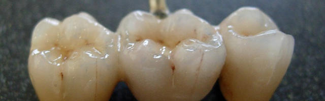 Lavori protesici in corso: i ponti dentali