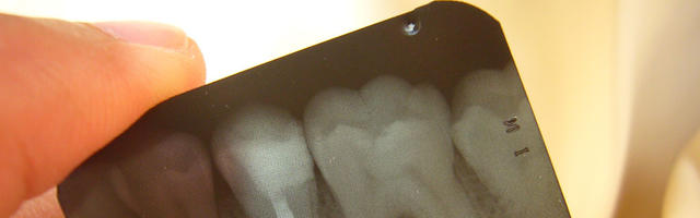 Cosa dovete sapere e chiedere prima di una devitalizzazione