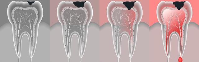 Treating A Root Apical Cyst With A Root Canal Treatment