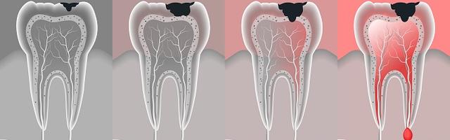 “The pain is killing me!”- How To Spot Dentine Troubles