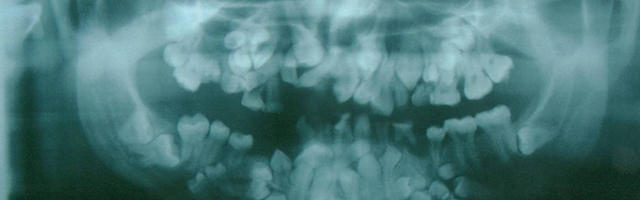 I denti sovrannumerari