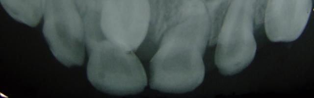 Supernumerary teeth