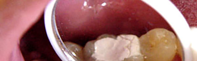 Fillings or Inlay?