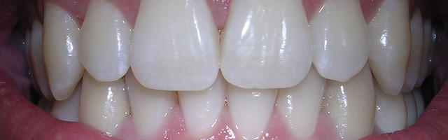 8 Tips to protect your tooth enamel