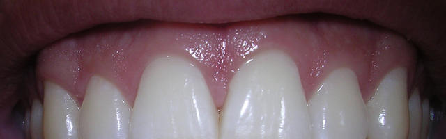 8 consigli per proteggere lo smalto dentale