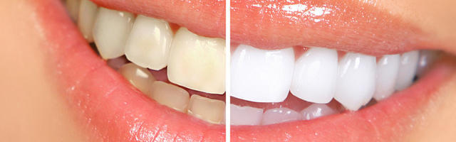 Perils Of Tooth Whitening
