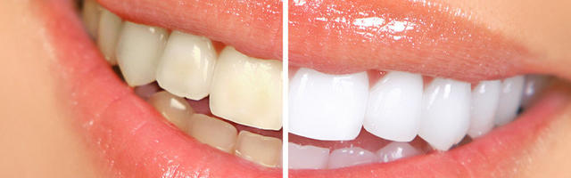 Teeth Looking Yellow After Orthodontic Braces