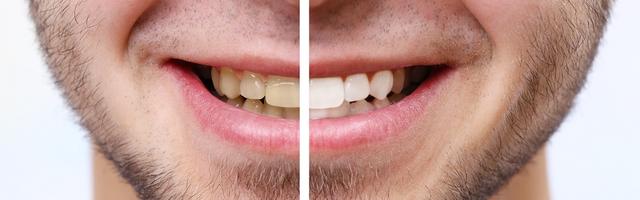 7 passaggi per l'utilizzo di un kit professionale per lo sbiancamento dei denti