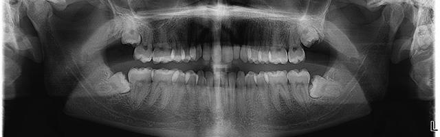 Wisdom Teeth Issues