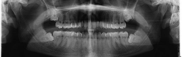 When Not To Extract Wisdom Teeth