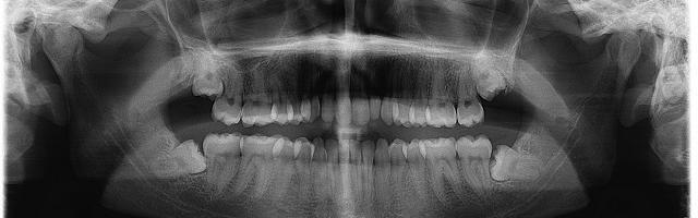 Cosa ti puoi aspettare da un’estrazione del dente del giudizio