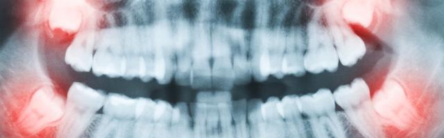 Il mistero delle radiografie dentali: i pro e i contro