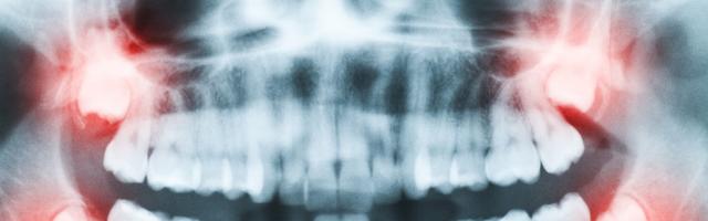 Are wisdom teeth necessary?