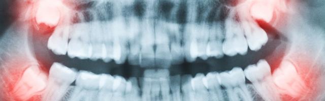 What Can You Expect From A Wisdom Tooth Extraction?