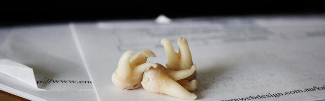 Problemi di denti del giudizio