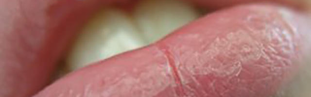 Xerostomia: una parola misteriosa ancora per poco...