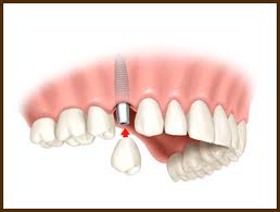 sing.tooth