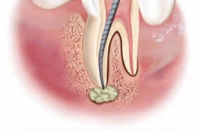 crescita sulla radice del dente