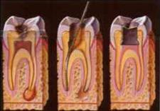 crescita sulla radice del dente