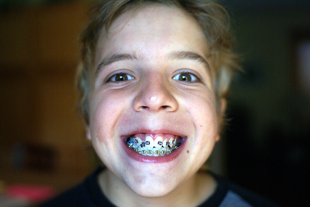 When To Start Our Child’s Orthodontic Treatment?