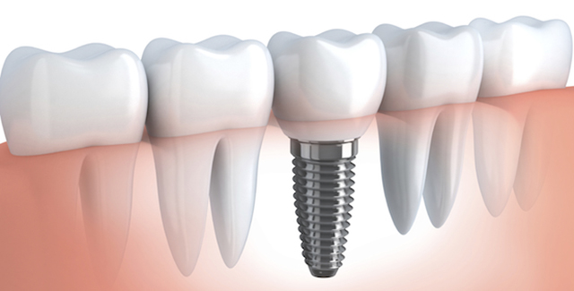 How Long Do Dental Implants Last?