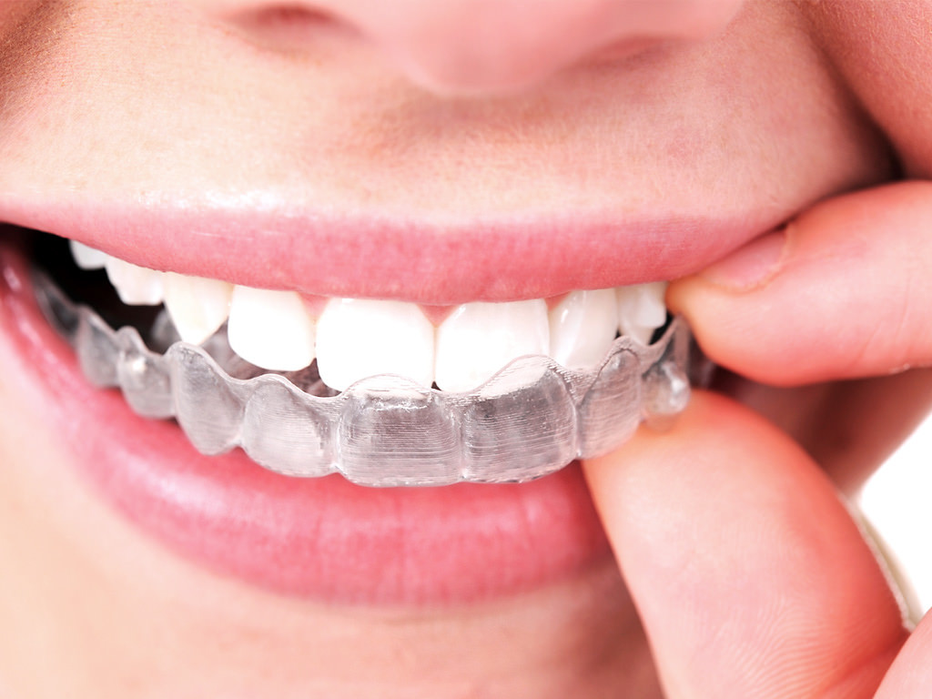 What to Expect from Invisalign®
