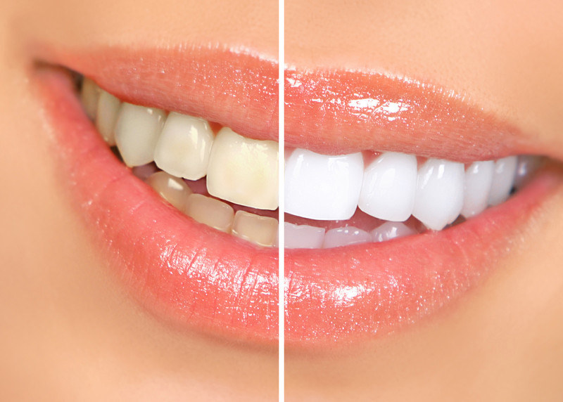 Tooth whitening is super effective at removing stains from teeth