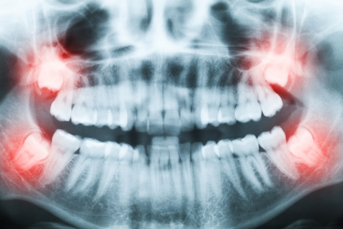 What Can You Expect From A Wisdom Tooth Extraction?