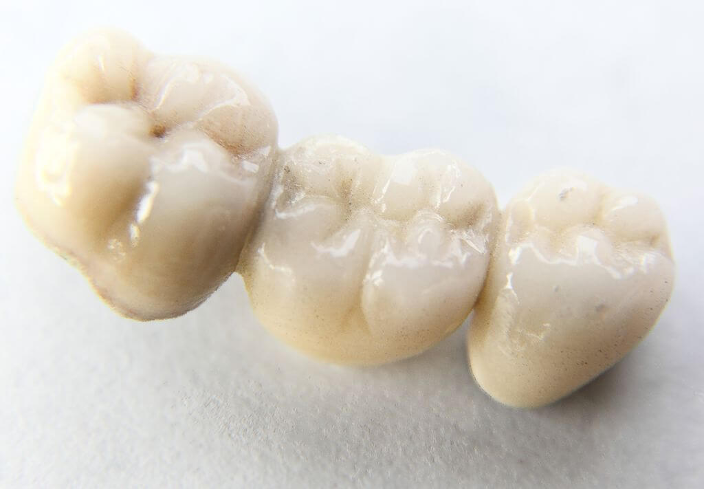 dental bridge
