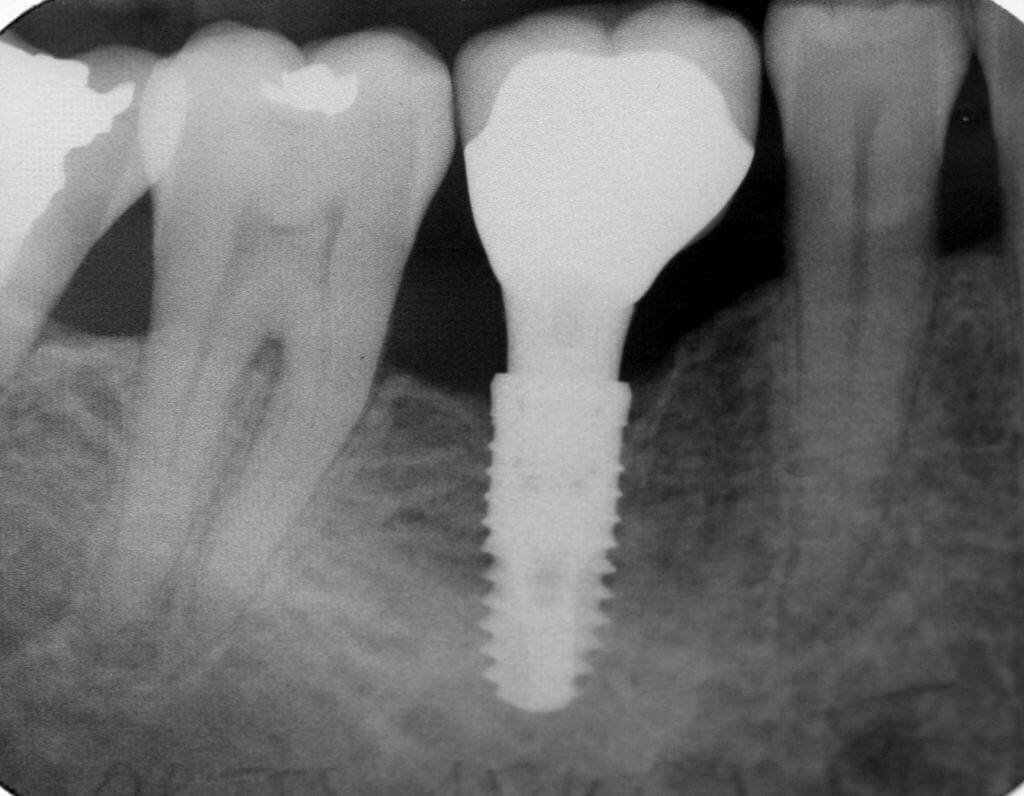 implant dental