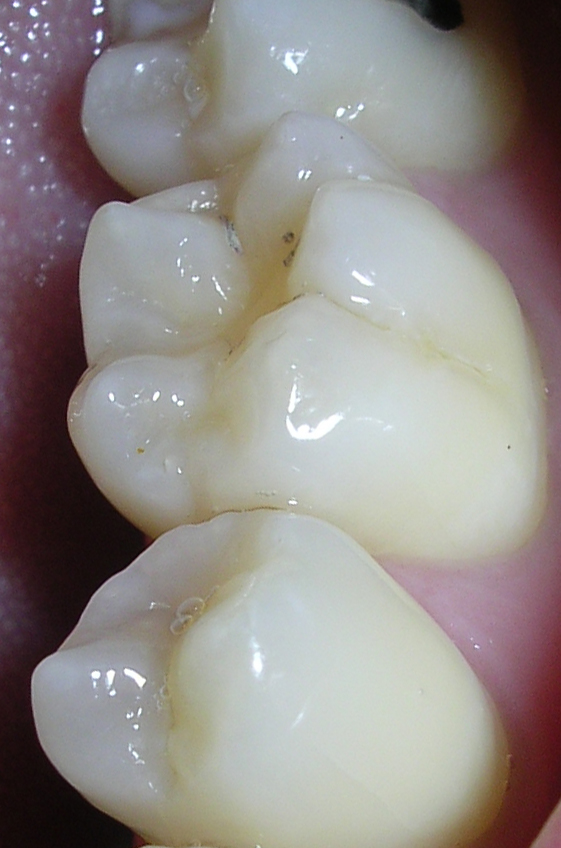 molar
