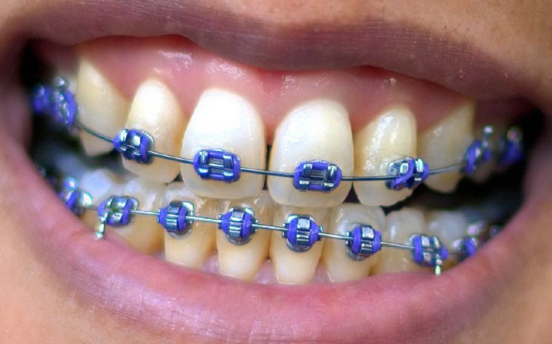 orthodontic treatment