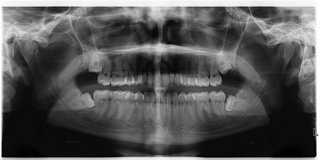 When Not To Extract Wisdom Teeth